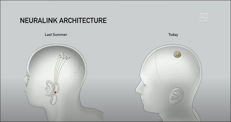 Neuralink 大腦晶片首位試驗者